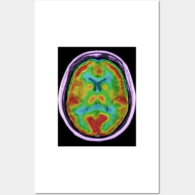 Normal brain blood flow, MRI and SPECT (C026/8000) Wall Art by SciencePhoto